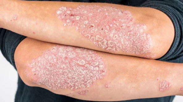 건선